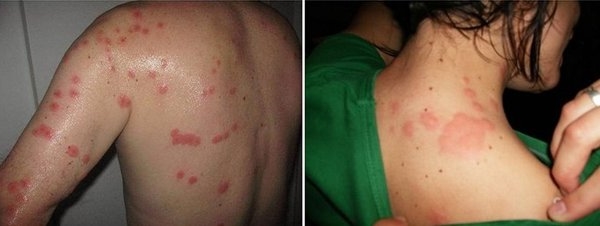 Укусы клопов Укусы клопов фото